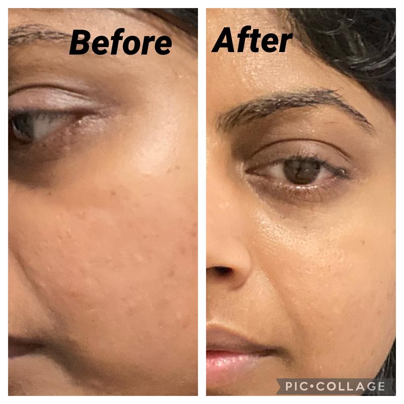 Reduction in smile lines