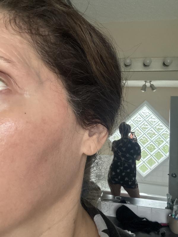 Forehead and expression lines at the end of the eyes