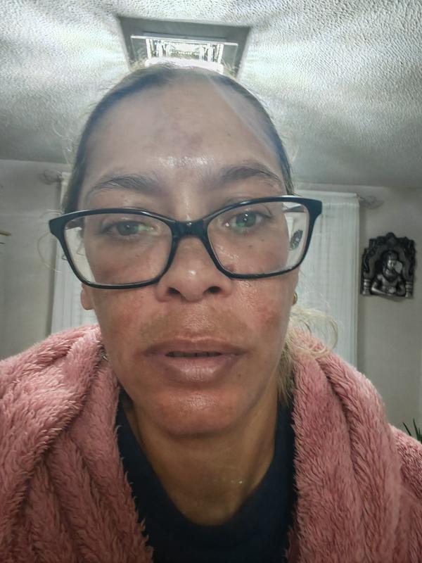 My skin after applying Vichy 89 Booster serum.