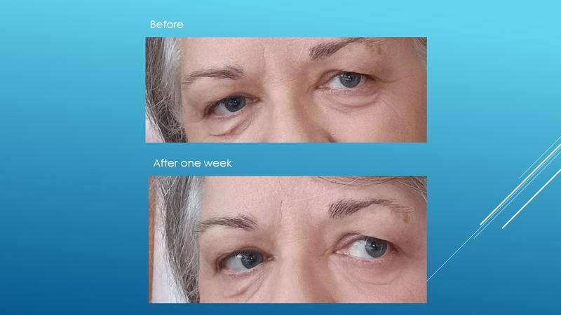 Before and after using the eye cream; its effect on my under eyes skin area