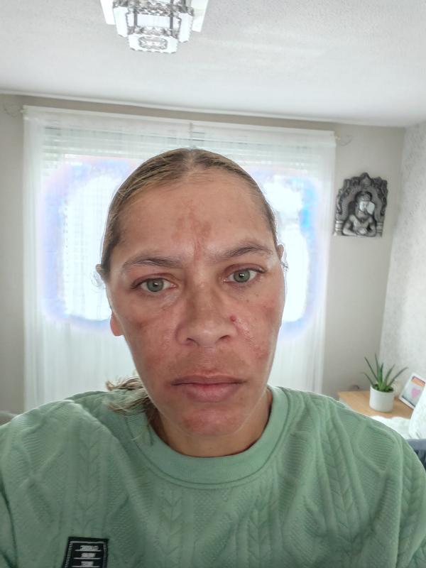 My skin after applying Vichy 89 Booster serum.