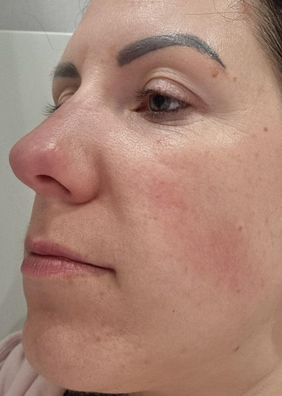 My skin after applying serym